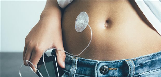 Zu sehen ist ein Bauch an dem eine Insulinpumpe angebracht ist. 