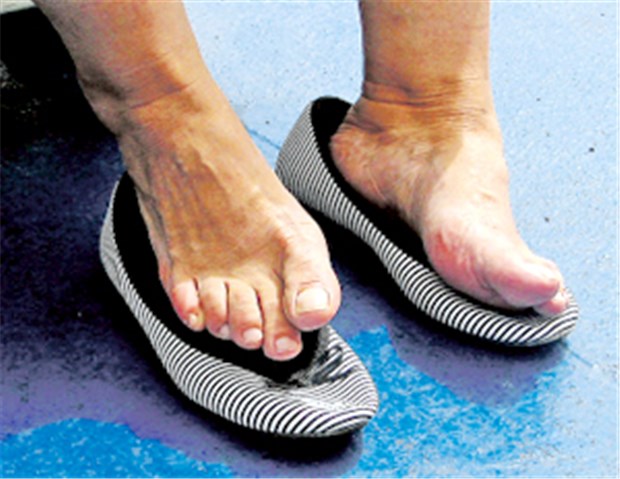 Zu enge Schuhe sind bei Diabetikern kein Kavaliersdelikt. Im Gegenteil: Sie können sogar den Fuß kosten.