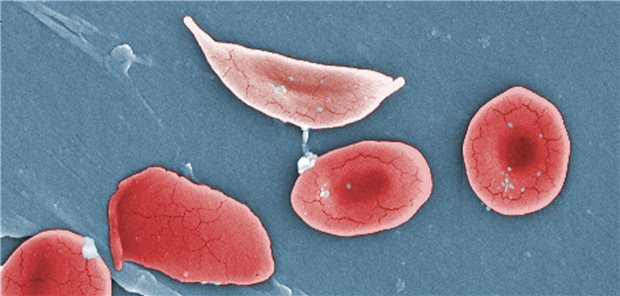 Für die Sichelzellerkrankung typischen verformten Erythrozyten, die der Erkrankung den Namen geben