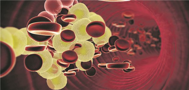Zu viel Fette im Blut: Dyslipidämie war bei einer Registeranalyse der häufigste vaskuläre Risikofaktor beim akuten ischämischen Schlaganfall.