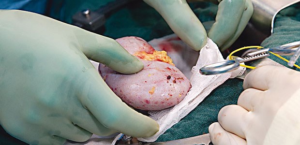 Transplanteure suchen den Befreiungsschlag Zu wenige Nieren: Seit zwei Jahren sinkt in Deutschland die Zahl der postmortal gespendeten Organe, beklagen die Transplanteure.