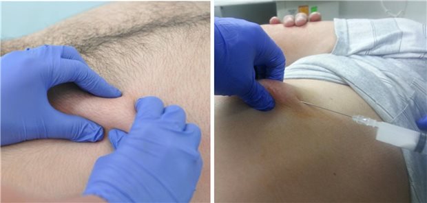 Zum Auffinden des Triggerpunktes wird eine Weichgewebefalte zwischen Daumen und Fingern beider Hände gegriffen und am Körper entlang gerollt – ähnlich wie zum Auffinden von Myogelosen am Rücken. Mit der nicht dominanten Hand wird das Weichgewebe – mit dem zuvor palpierten Triggerpunkt zwischen Daumen und Zeigefinger – angehoben und die Injektionsnadel parallel zur Körperoberfläche darauf zugeführt.