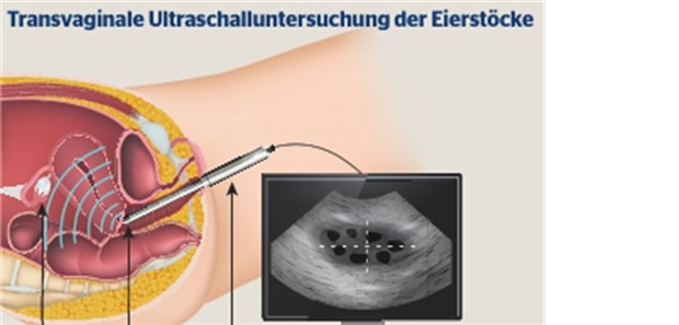 Ein Screening auf Ovarial-Ca ist auch weiter nicht in Sicht Zum Screening auf Ovarialkarzinome werden der transvaginale Ultraschall und der Serumtest auf den Tumormarker CA-125 geprüft.