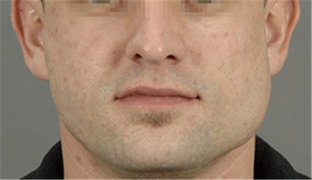 Zähneknirschen als "Bodybuilding" für die Wangenmuskulatur Zunehmende Wangenschwellung durch Bruxismus.