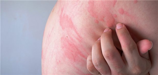 Rote Kratzspuren auf der Haut wegen einer Urtikaria.