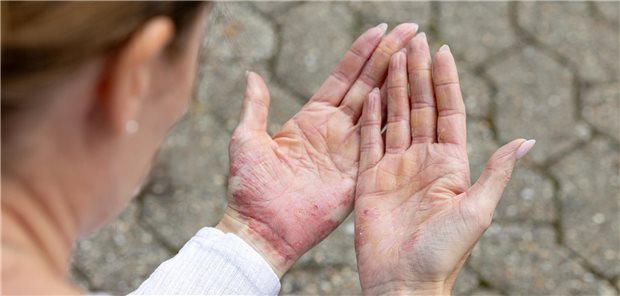 Hauterkrankungen wie Ekzeme können sichtbare Beschwerden an den Händen verursachen.