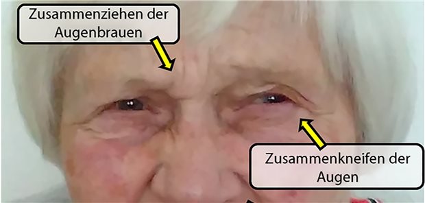 Zusammengezogene Augenbrauen sind bei Demenz-Kranken ein möglicherHinweis auf Schmerzen.