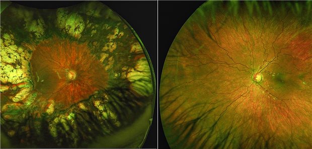 Zustand nach Laserkoagulation mit großflächigen Narben (links) bei behandlungsbedürftiger Frühgeborenenretinoptahie und nach Behandlung mit VEGF-Hemmer (rechts).