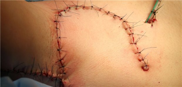 Zustand nach nach Op von Acne inversa in der Axilla: Bei einer Therapie mit Adalimumab muss das Medikament vor dem Eingriff nicht abgesetzt werden, hat eine Multicenterstudie ergeben.