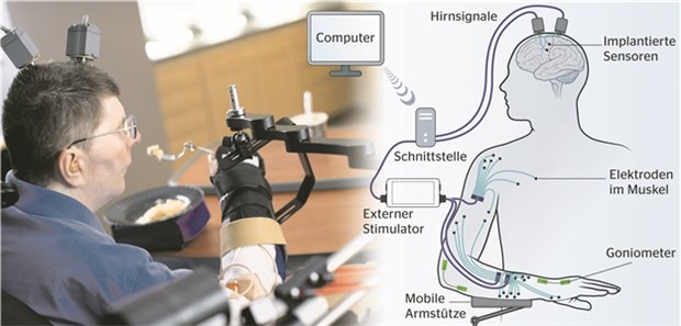 Mit Neuroprothese kann ein Gelähmter wieder zugreifen Zwei Jahre nach Implantation der System-Komponenten hat der Patient gelernt, mit einer Gabel zu essen und aus einer Tasse zu trinken.