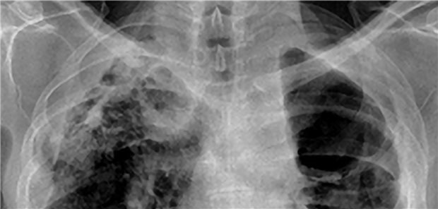 Zwerchfellhochstand links nach Oberlappenteilresektion bei Aspergillom, apikolateral rechts Kavität mit zystischer Destruktion des Oberlappens und kranialer Hilusraffung.
