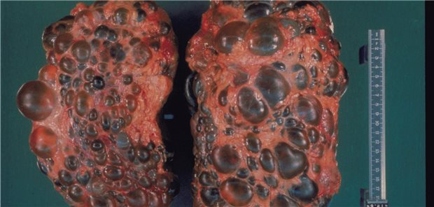 Zystennieren. Forscher suchen nach neuen Therapieoptionen für Betroffene.